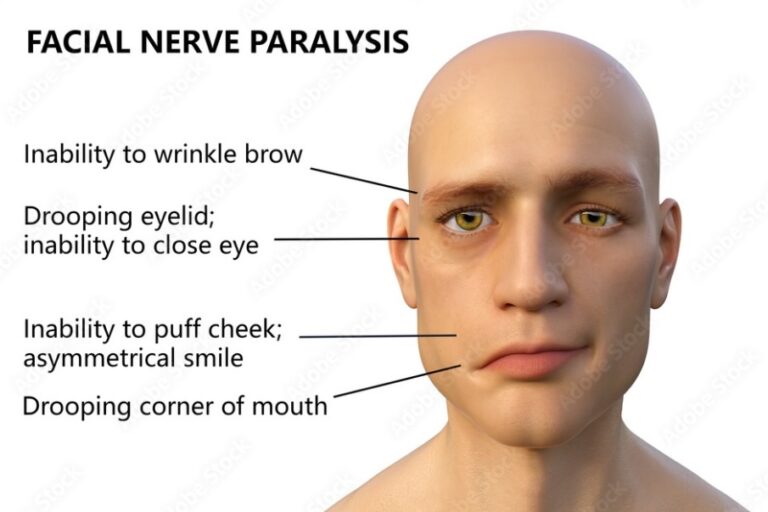 bells-palsy-exposure-to-cold-in-winters-can-cause-paralysis-of-face