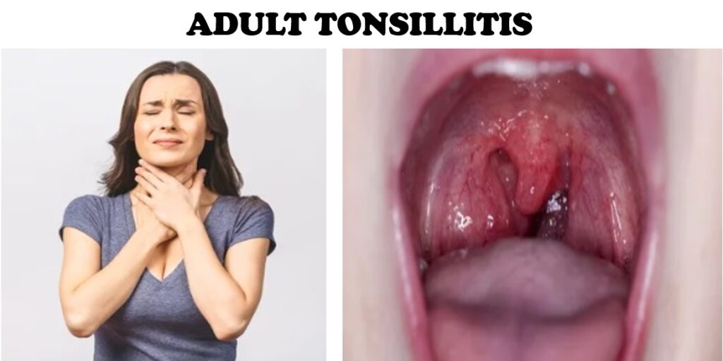 adult-tonsillitis-symptoms-diagnosis-treatment-and-care