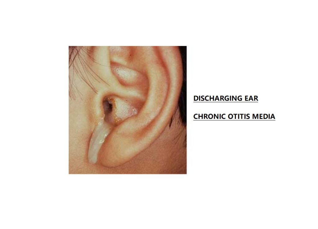 Do Your Ears Discharge? What is Chronic Otitis Media? Dr. Sharad ENT