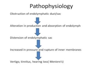 What is Meniere's Disease? Symptoms, Diagnosis, and Treatment