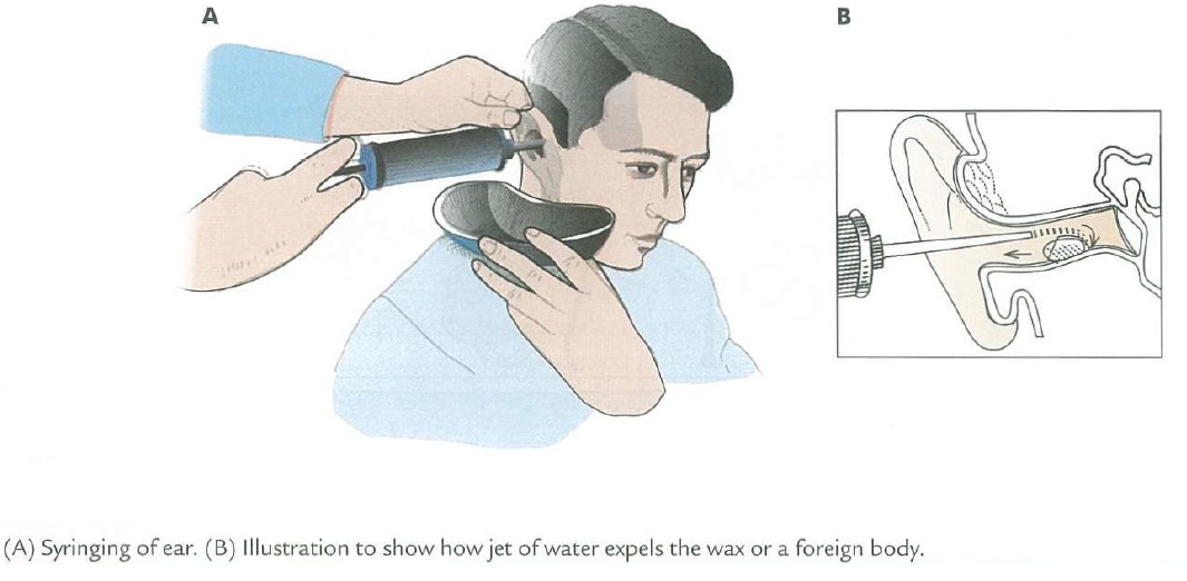 The Safest Way to clean your Ear Ear Syringing or Ear Irrigation