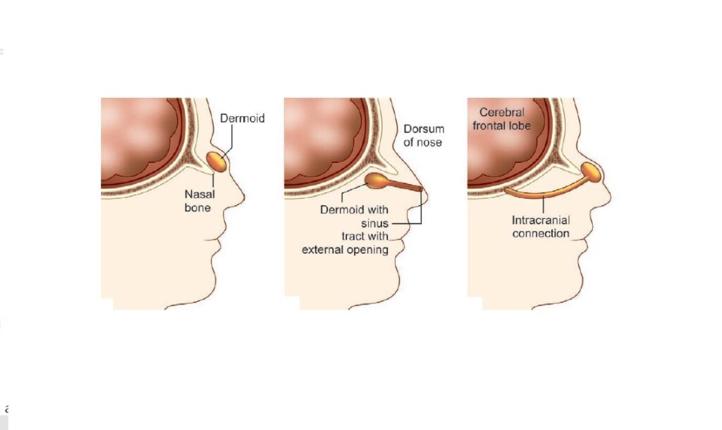 What Is Dermoid Cyst On The Nose Dr Sharad Ent Specialist 5557