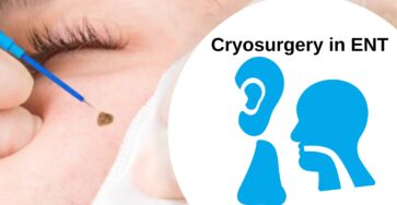 Cryosurgery in ENT