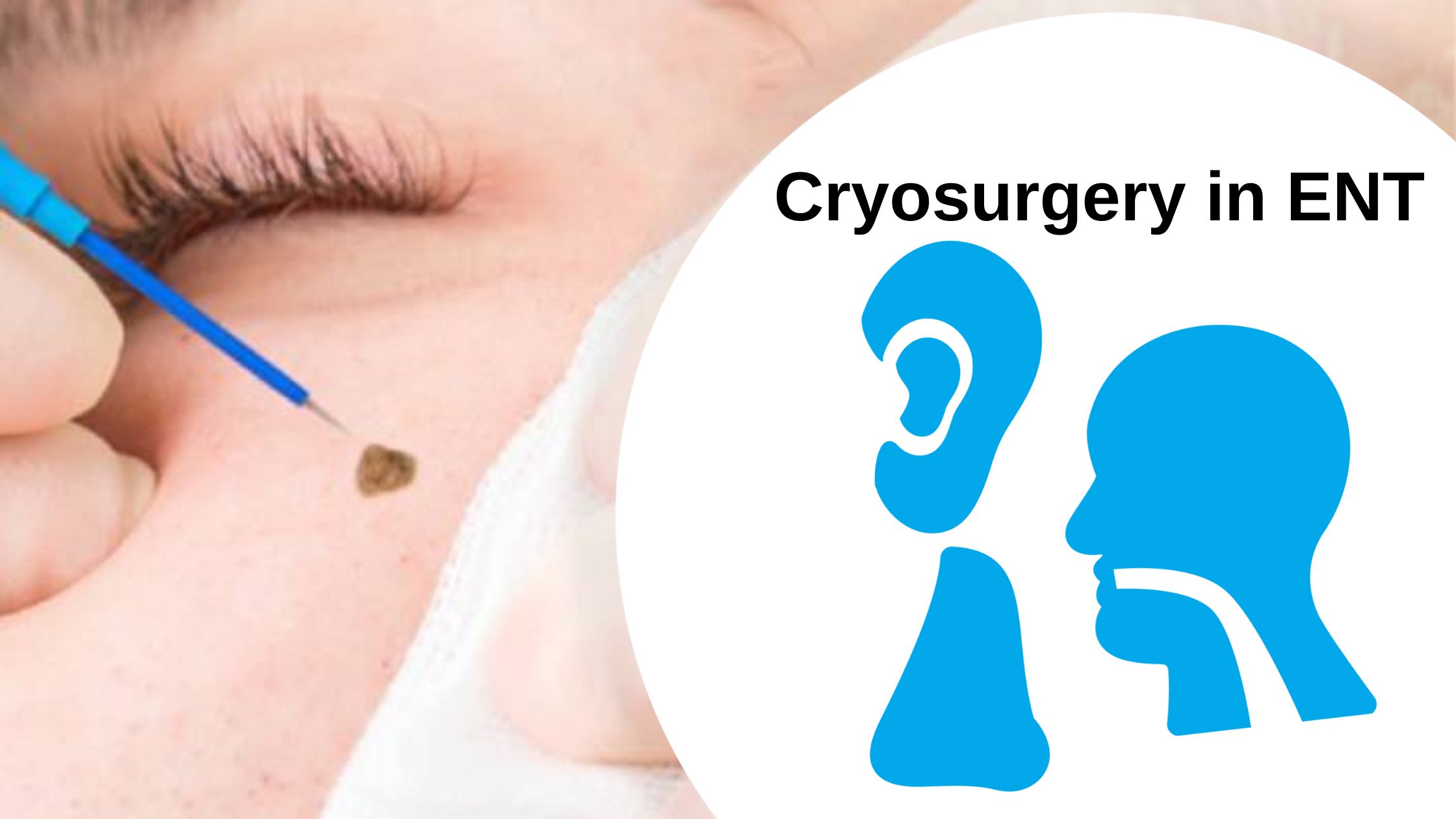 Cryosurgery in ENT