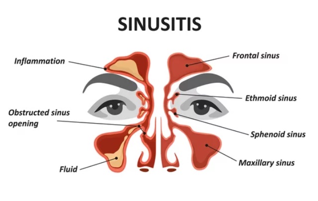 Acute Sinusitis Treatment